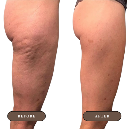 Cellulite Smoothing Oil